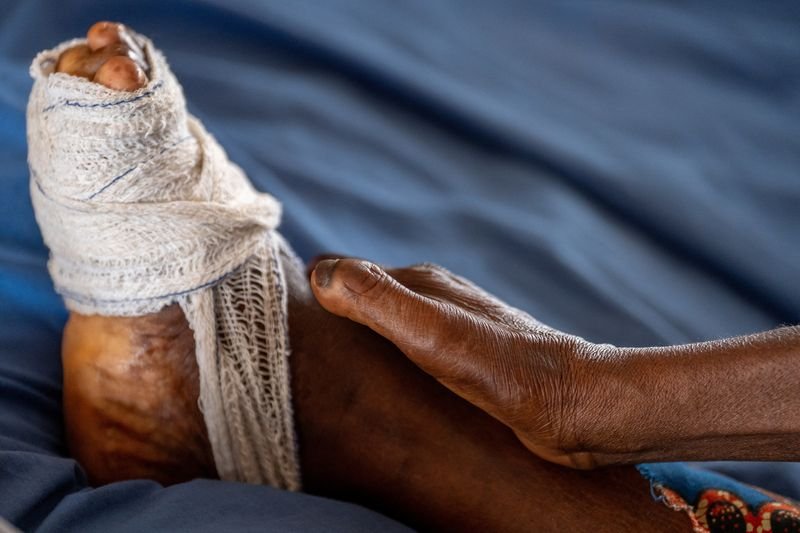 2025 03 07t085343z 1 lynxnpel260bz rtroptp 3 nigeria health leprosy