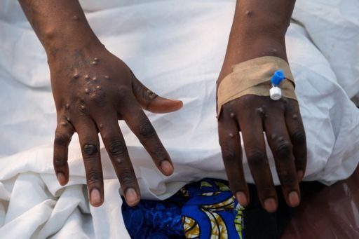 2024 09 02t181309z 335071699 rc2e eh5u9 rtrmadp 3 health mpox congo